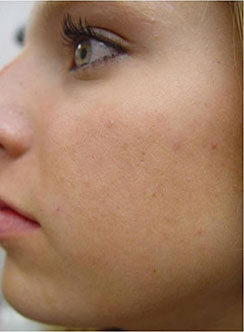 Vivace & Secret Fraxis RF MicroNeedling