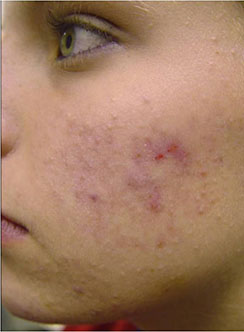 Vivace & Secret Fraxis RF MicroNeedling